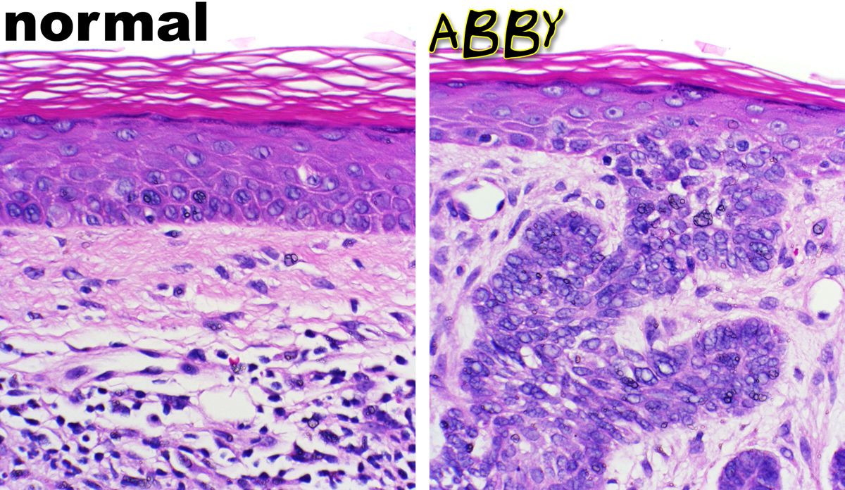 merkel cell carcinoma pictures #11