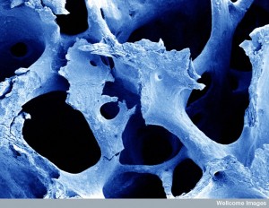 B0004814 SEM of osteoporotic bone Credit: David Gregory&Debbie Marshall. Wellcome Images images@wellcome.ac.uk http://wellcomeimages.org Scannign electron micrograph of osteoporotic bone, computer-coloured blue. Scanning electron micrograph 2003 Published: - Copyrighted work available under Creative Commons by-nc-nd 4.0, see http://wellcomeimages.org/indexplus/page/Prices.html