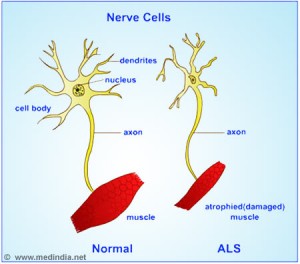 Normal nerve cell (left) and damaged ALS nerve cell (right) (Source: Mahesh Kumar - via Flickr - https://www.flickr.com/photos/maheshmedindia/7182628151/in/photolist-bWGR7p-8x8Vhw-mrehCZ-mrg65y-mreikk-b8j56g-bSpVqD-oXmggM-bu1MUH-JkXVq-dSh244-paFp4a-sbRLs-9ycT8J-s71EA-9jCphF-6ixrC8-jnEixn-nEAfpf-pGGChv-jnEiDK-bxmLCd-bxmLDj-bLgssZ-bxmLAu-bxmLBd-5vaBWM-5AqpP1-pqic1f-6d5Ebb-6d5Cfh-8TBvE4-8TBvVD-8DJYEE-8DJYDG-8DFSjD-5AqpJw-6d5Kch-8TF1qb-91VyCH-8TF2L3-8TBX4v-8TBY46-8TF5xW-3pJCp3-3pE4Pz-91YFdu-8TBZVF-8TF7Mo-6d5Bom 
