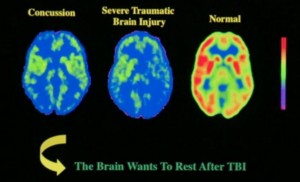 normal-severe-tbi-concussion-images