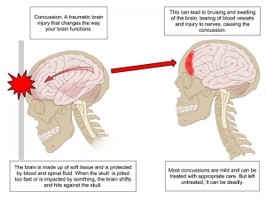 How a concussion is caused, courtesy of Wikimedia Commons