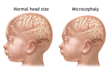 Figure 1: The comparison of infant's head size without Zika virus versus with Zika virus 