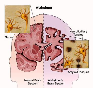 Normal brain and a brain with Alzheimer's disease