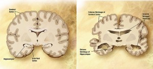 "Normal Aged brain vs Alzheimer's patient"