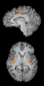 Region of Posterior Insula activated in brain from math anxiety. Image Source: Science Daily.