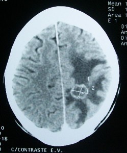 Cerebral edema surrounding brain tumor.  Image source: Wikimedia Commons. 