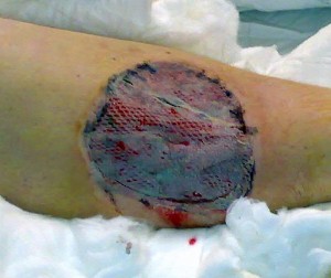 Skin graft.  Image credit: Wikipedia 