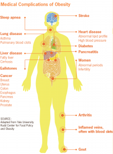 Medical_complications_of_obesity