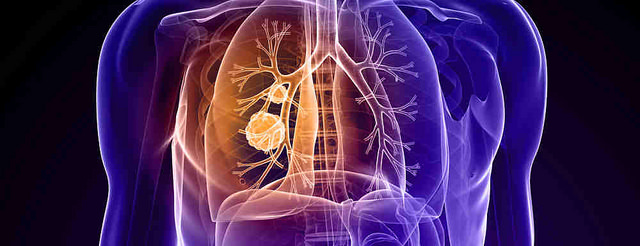 The Presence of Lung Cancer Source: Flickr Commons