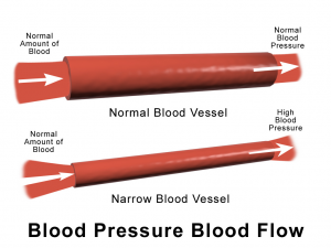 A visual of what constriction of blood vessels looks like - can be caused by high blood pressure. (Via Wikimedia Commons)