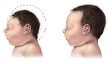 baby with microcephaly (left) compared to typical baby head size. Image from wikipedia