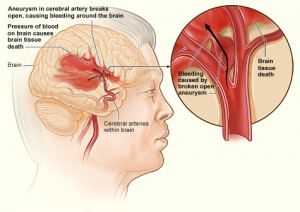 Illustration of hemorrhagic stroke: Wikimedia commons by National Heart Lung and Blood Institute (NIH)