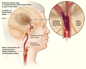 Illustration of ischemic stroke: Wikimedia commons by National Heart Lung and Blood Institute (NIH)