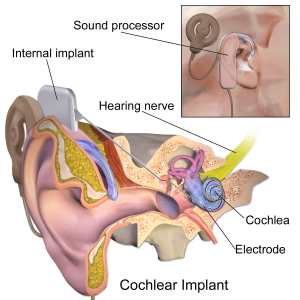 This is a schematic of a cochlear implant by Blausen.com staff.