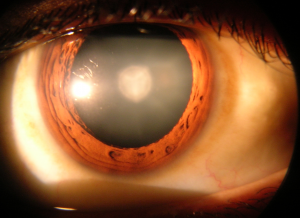 This is a cataract in a human eye taken by Dr. Rakesh Ahuja.
