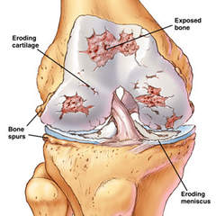 Damaged knee Cartilage. In this picture the Patella bone is not been shown. Image credit: http://www.chiropractic-books.com/Knee-Joint-Distraction.html