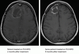 Comparison of a patient's brain tumour size after 2 and 9 months of viral cancer treatment. Source: www.dukecancerinstitute.org