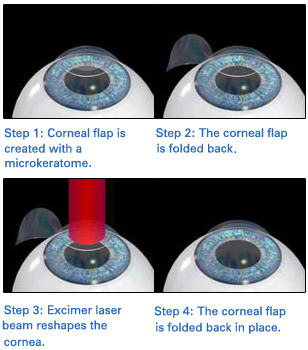 Does Not Wearing Glasses Mean Contact Lenses for Life? | Communicating ...