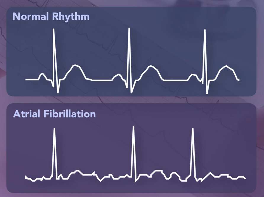 Atrial Fibrillation Communicating Science 2020w212