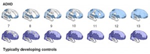 Adhd_brain_timelapse