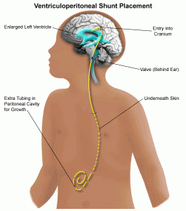 Ventriculoperitoneal Shunt Placement