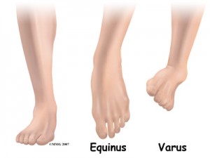 child_foot_clubfoot_anatomy